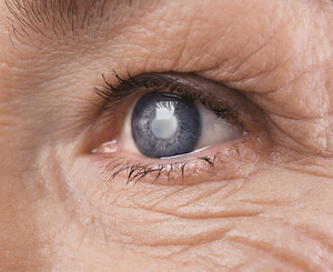 Grauer Star (Katarakt)