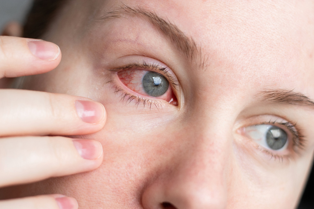 Rote Augen richtig einschätzen