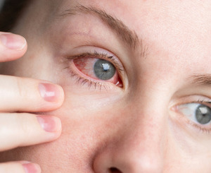 Rote Augen richtig einschätzen