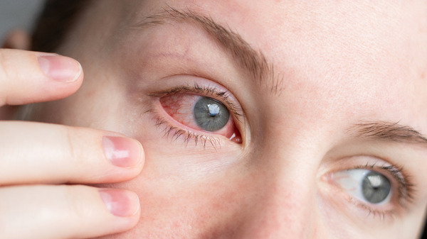 Rote Augen richtig einschätzen